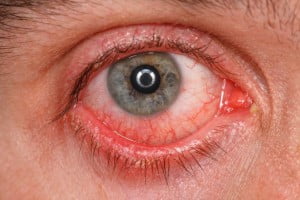 ojo afectado virus zika